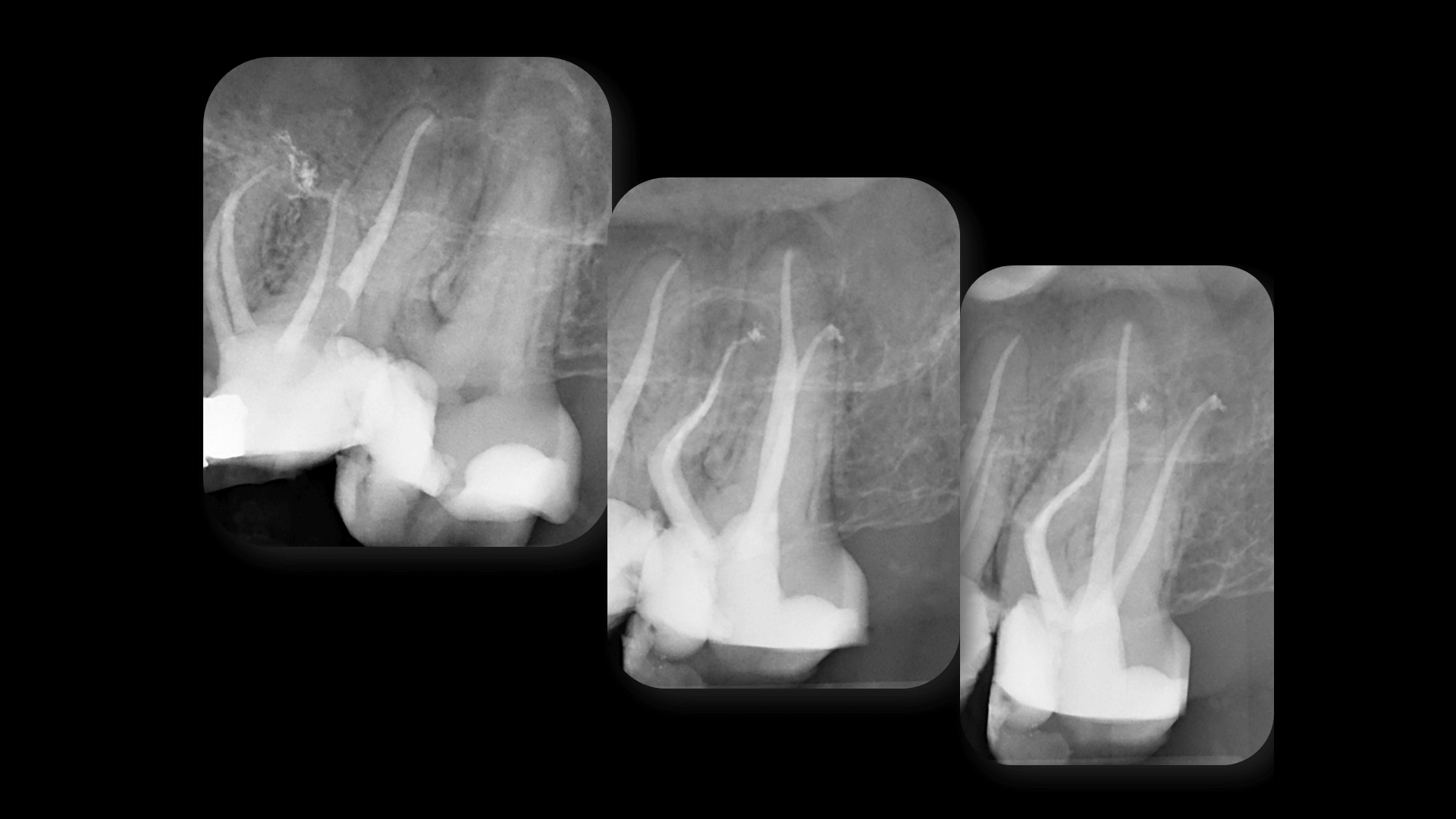 Broken Instrument Removal - Case 6